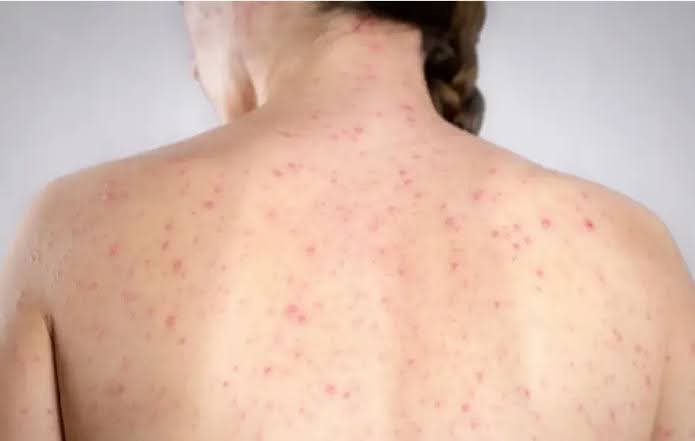 AUMENTAN CASOS DE SARAMPIÓN